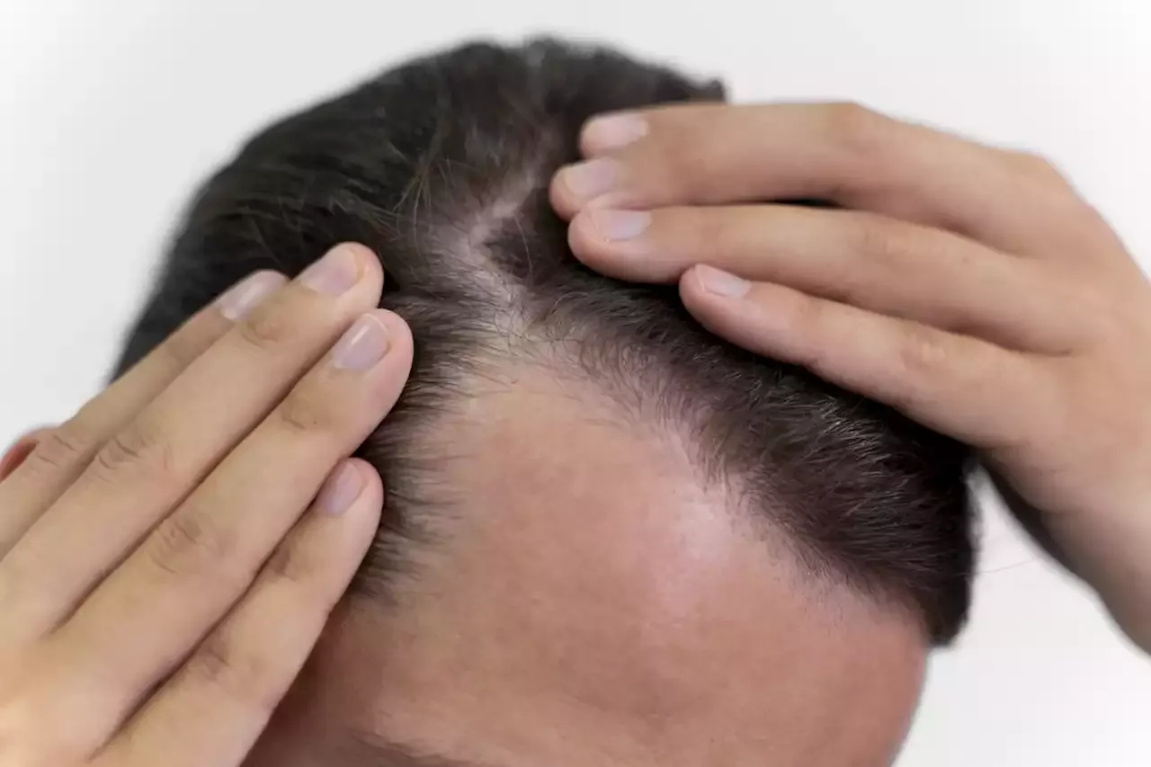 Minoxidil Para Que Serve Como Usar De Forma Correta E Efeitos Colaterais