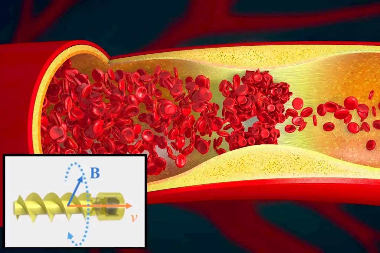 Corkscrew-shaped robot swims through blood vessels to clear blockages