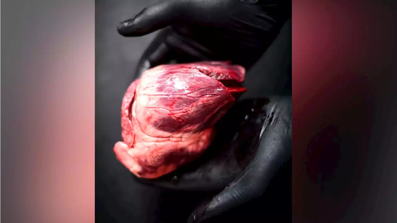 A Medical First: US Patient Gets Pig Heart Transplant