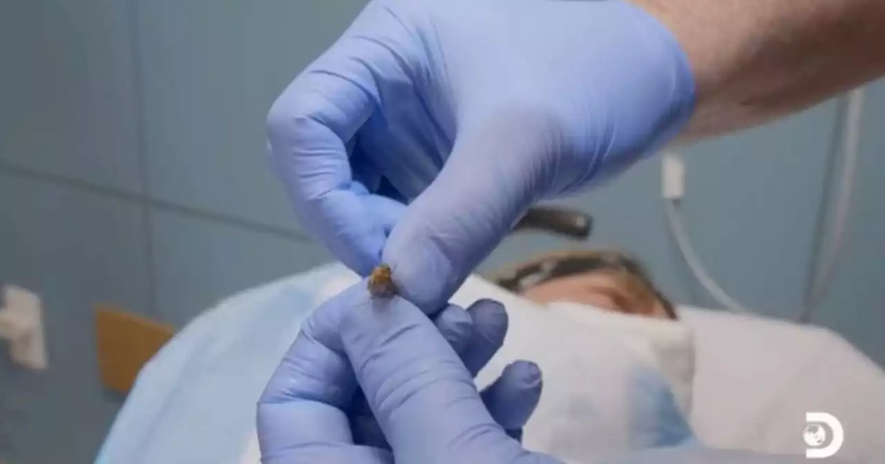 Man horrified as huge insect pulled out of ear alive in nightmare hospital visit