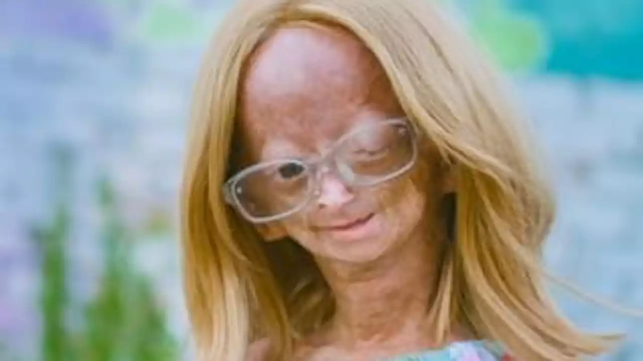 'She touched MILLIONS': YouTube sensation Adalia Rose, with rare genetic disease, dies at 15