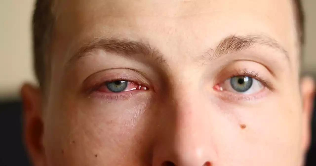 La conjuntivitis, un síntoma de COVID más común con la variante Ómicron