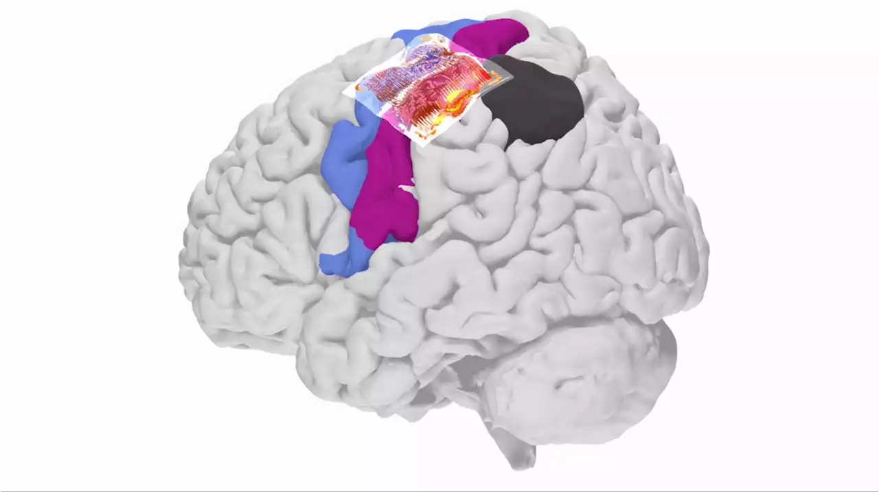 Human brain mapping with multithousand-channel PtNRGrids resolves spatiotemporal dynamics