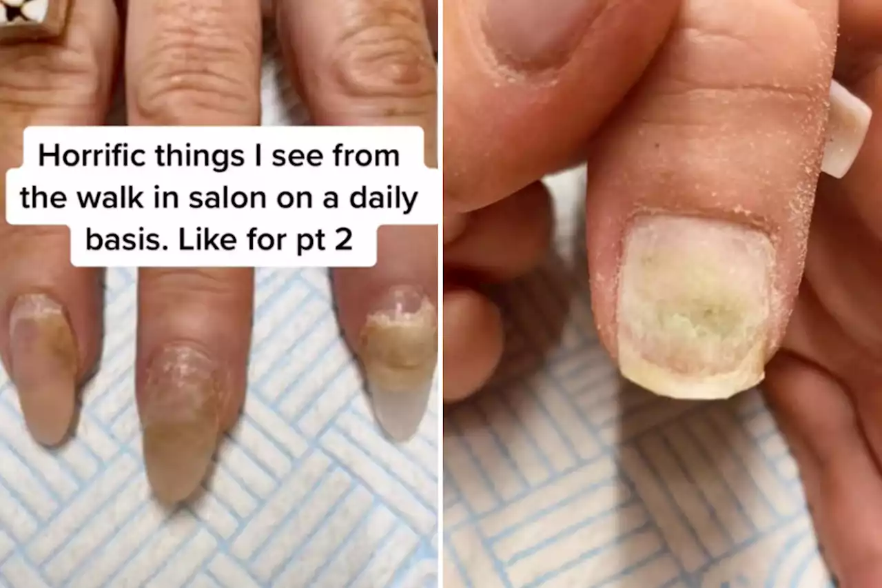 I work in a nail shop & these are the grimmest things I’ve seen, some were green