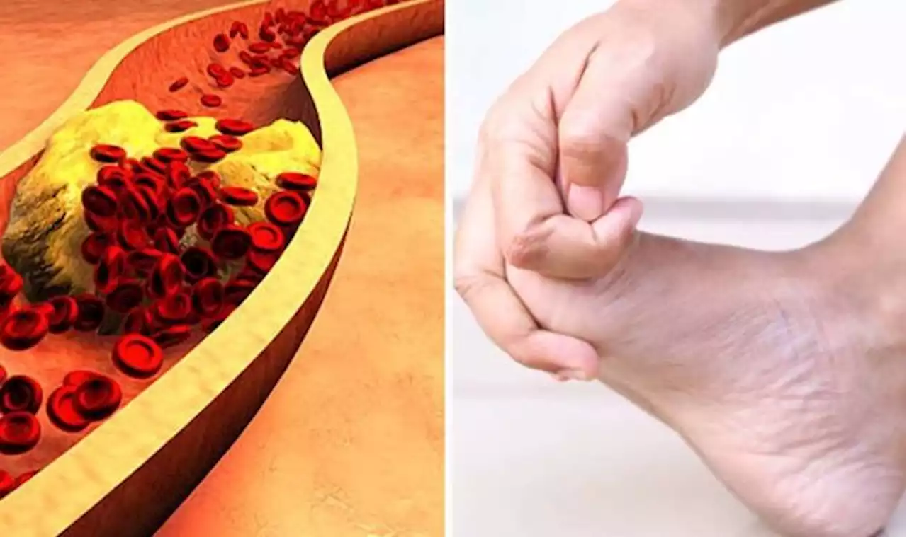 High cholesterol: Three signs on your toes that plaque has built up in the artery walls