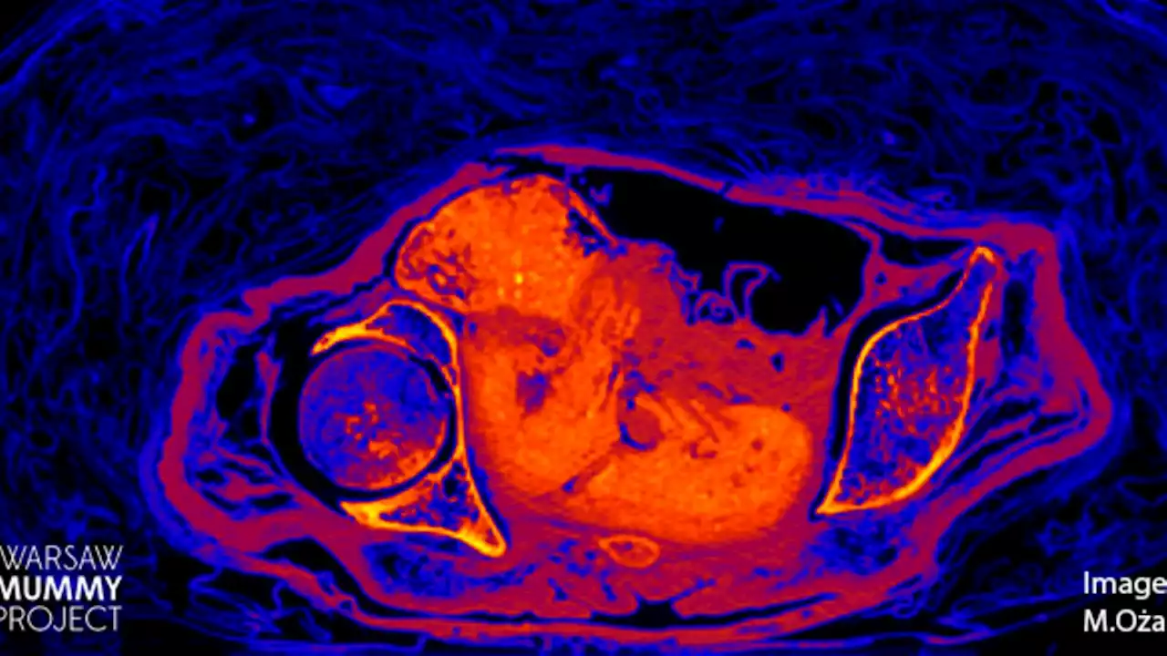 Fötus in 2000 Jahre alter Mumie: Forscher finden heraus, wie er so lange erhalten blieb