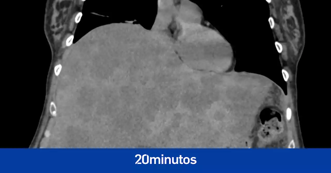Los síntomas 'sutiles' de cáncer de colon que podrían salvar vidas por el diagnóstico temprano