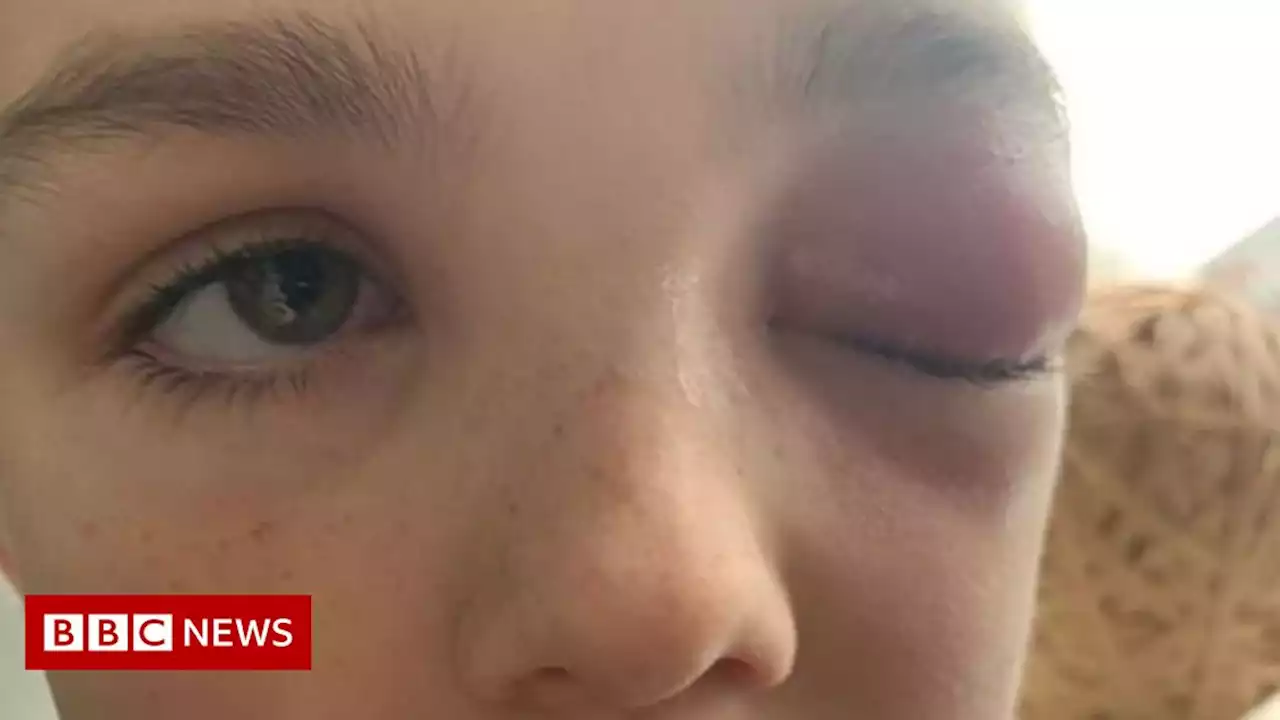 Covid: Boy 'almost blinded' by eye infection linked to virus