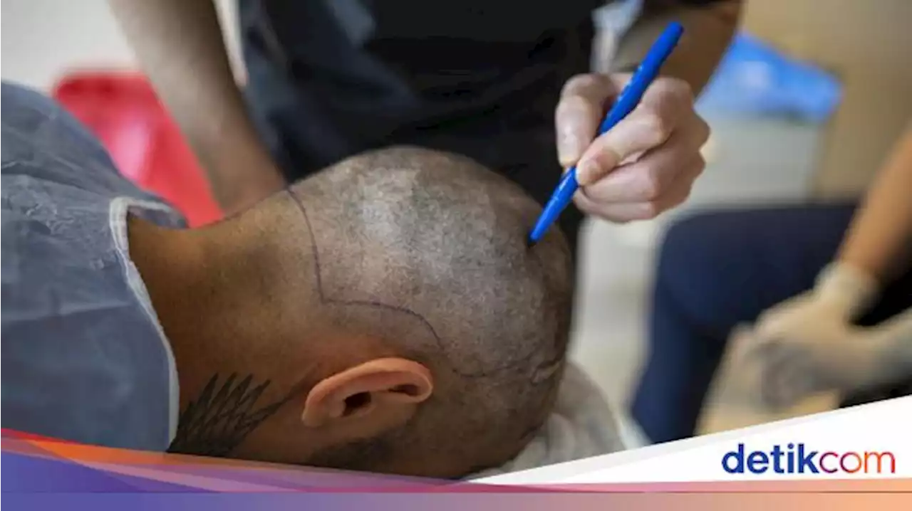 Transplantasi Rambut: Manfaat, Risiko, dan Kisaran Biaya