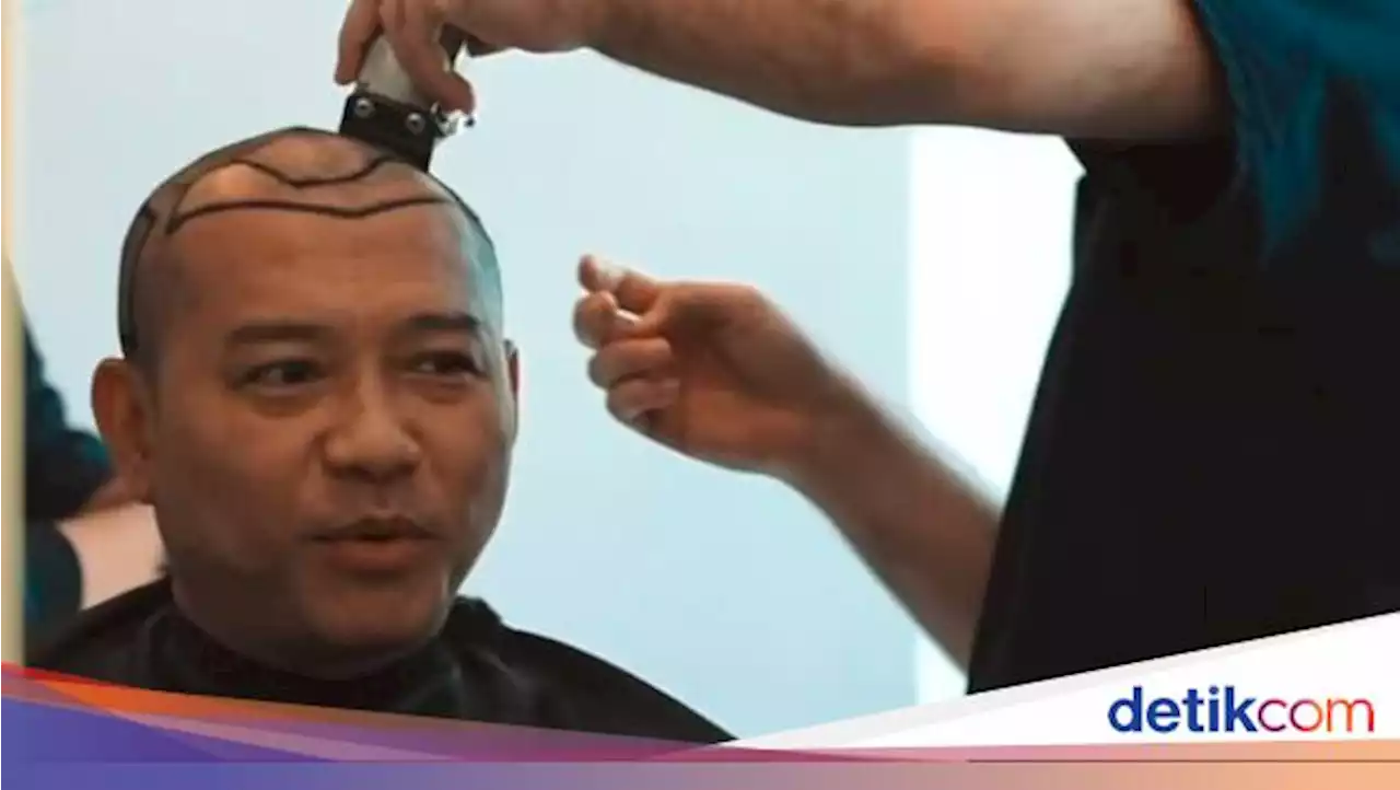 Transplantasi Rambut Seperti Anang-Atta, Seberapa Efektif Atasi Kebotakan?