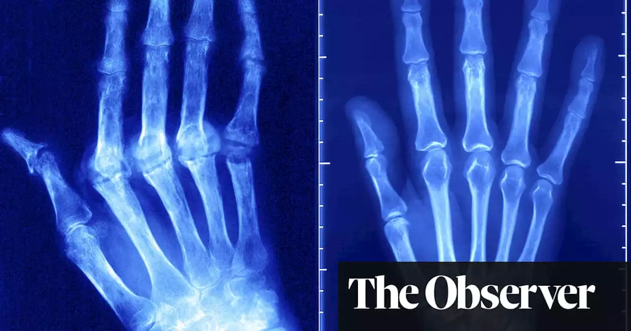 Global spread of autoimmune disease blamed on western diet