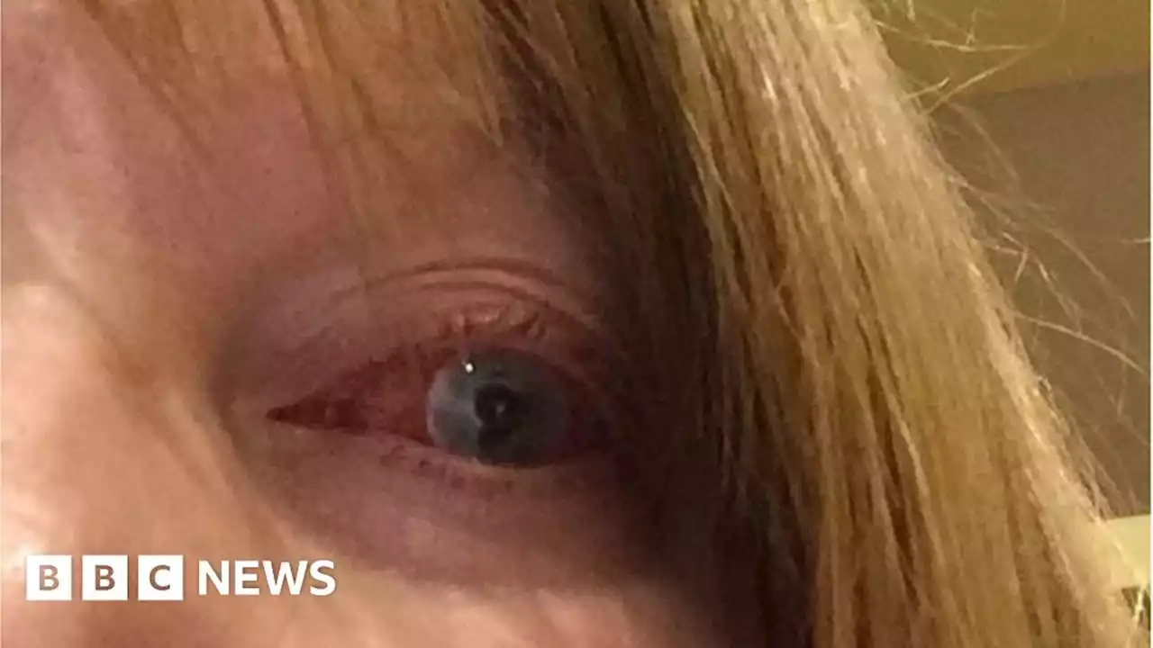 Leicestershire woman who lost eye calls for contact lens warnings