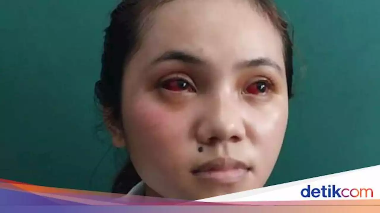 Mata Memerah, 3 Jari Mahasiswi Widyagama Korban Kanjuruhan juga Sulit Digerakkan