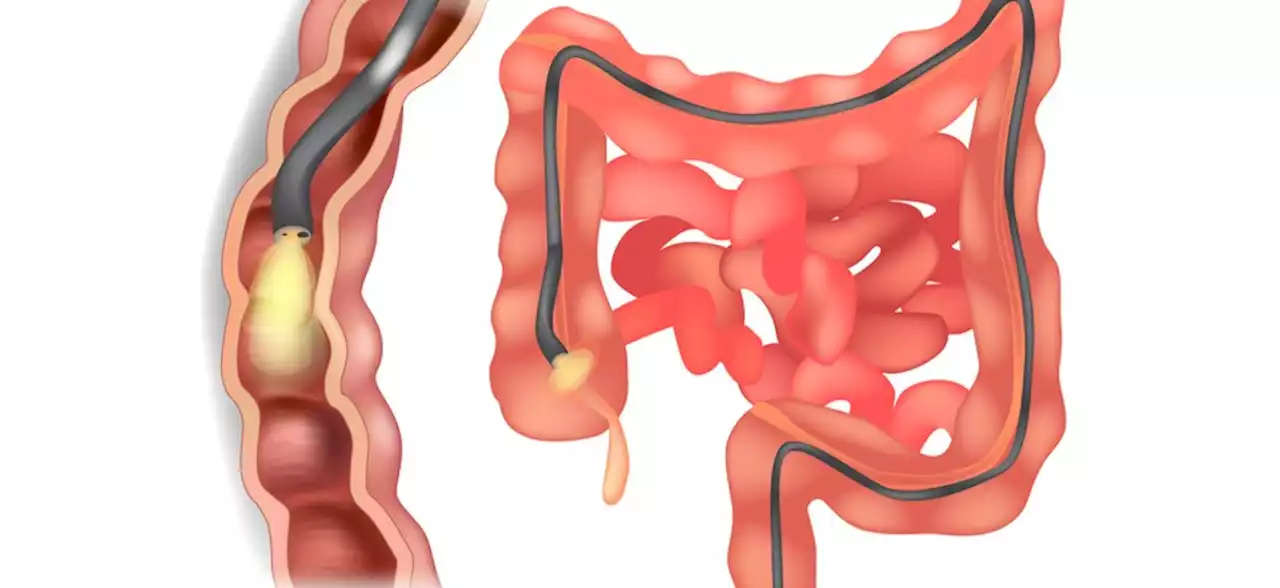 Challenges to Colonoscopy as Gold Standard for CRC Screening?