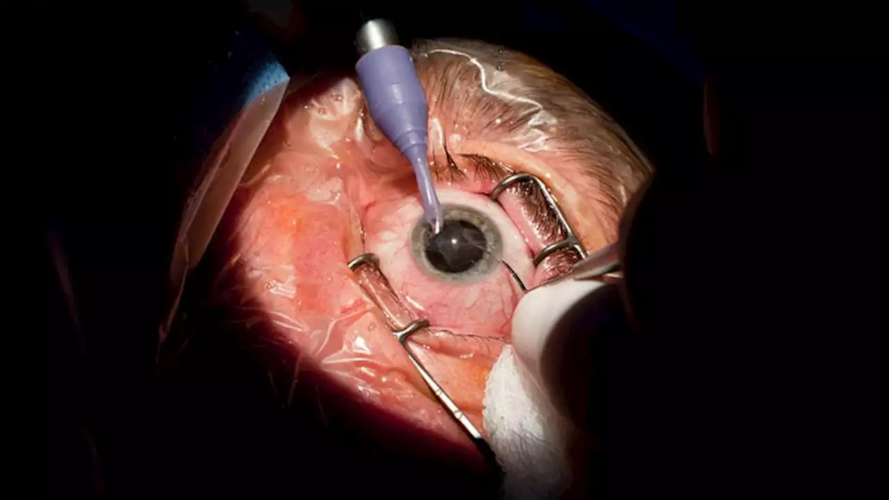 Posterior Capsule Rupture