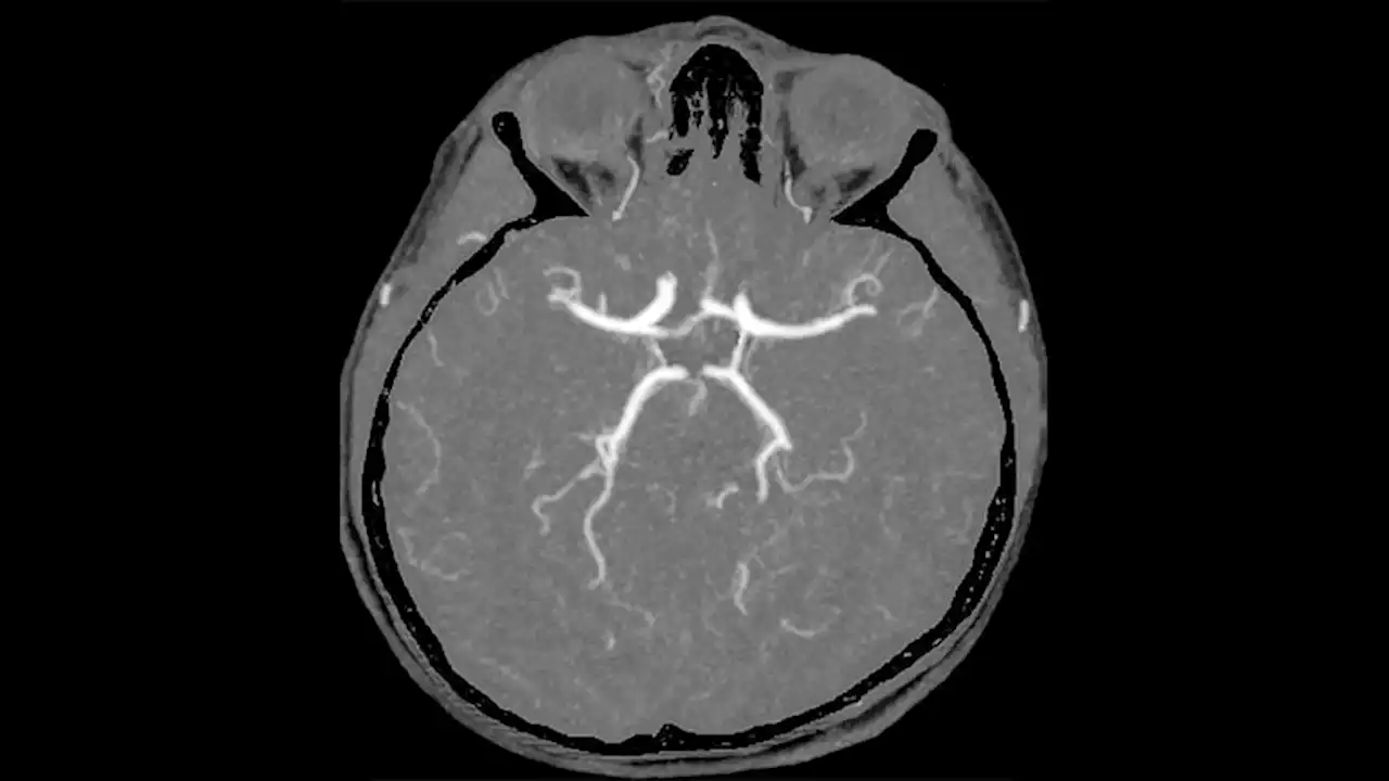 Success for Basilar Artery Stroke Thrombectomy: Trials Published