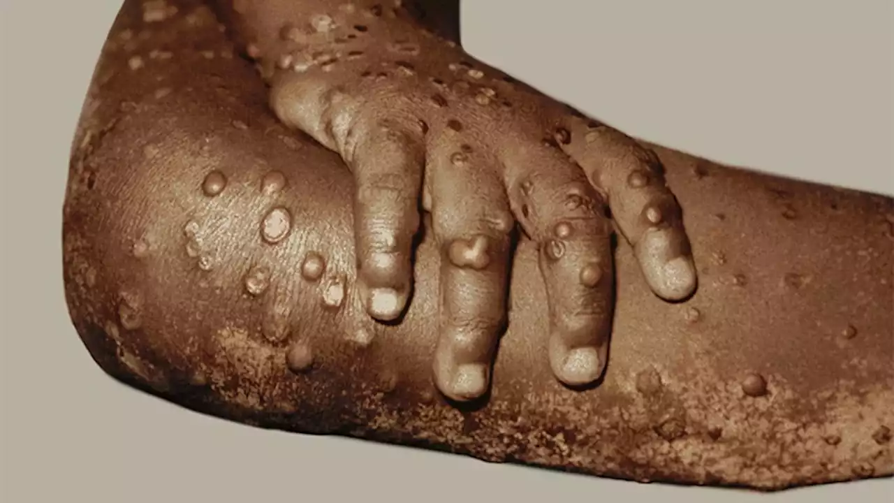 Monkeypox Case Rates 5 Times Higher Among Black Americans