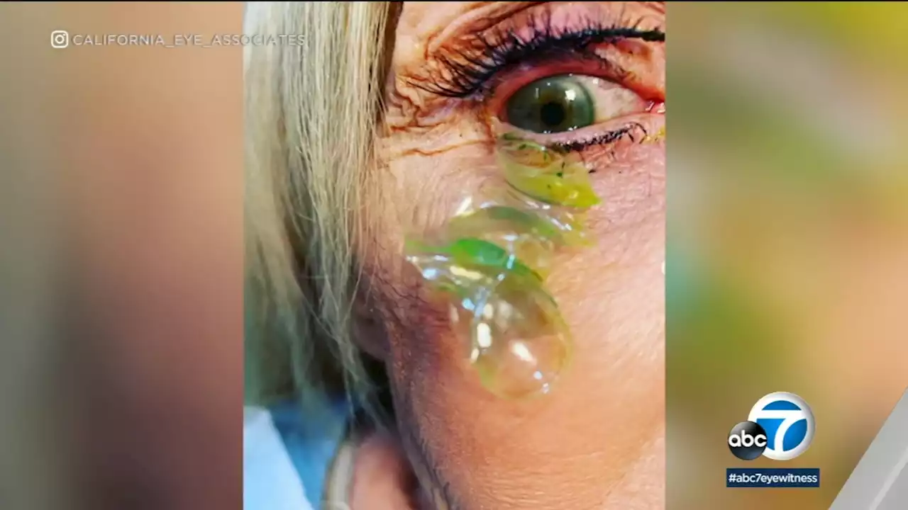 'Like a stack of pancakes': Newport Beach doctor removes 23 contact lenses from patient's eye