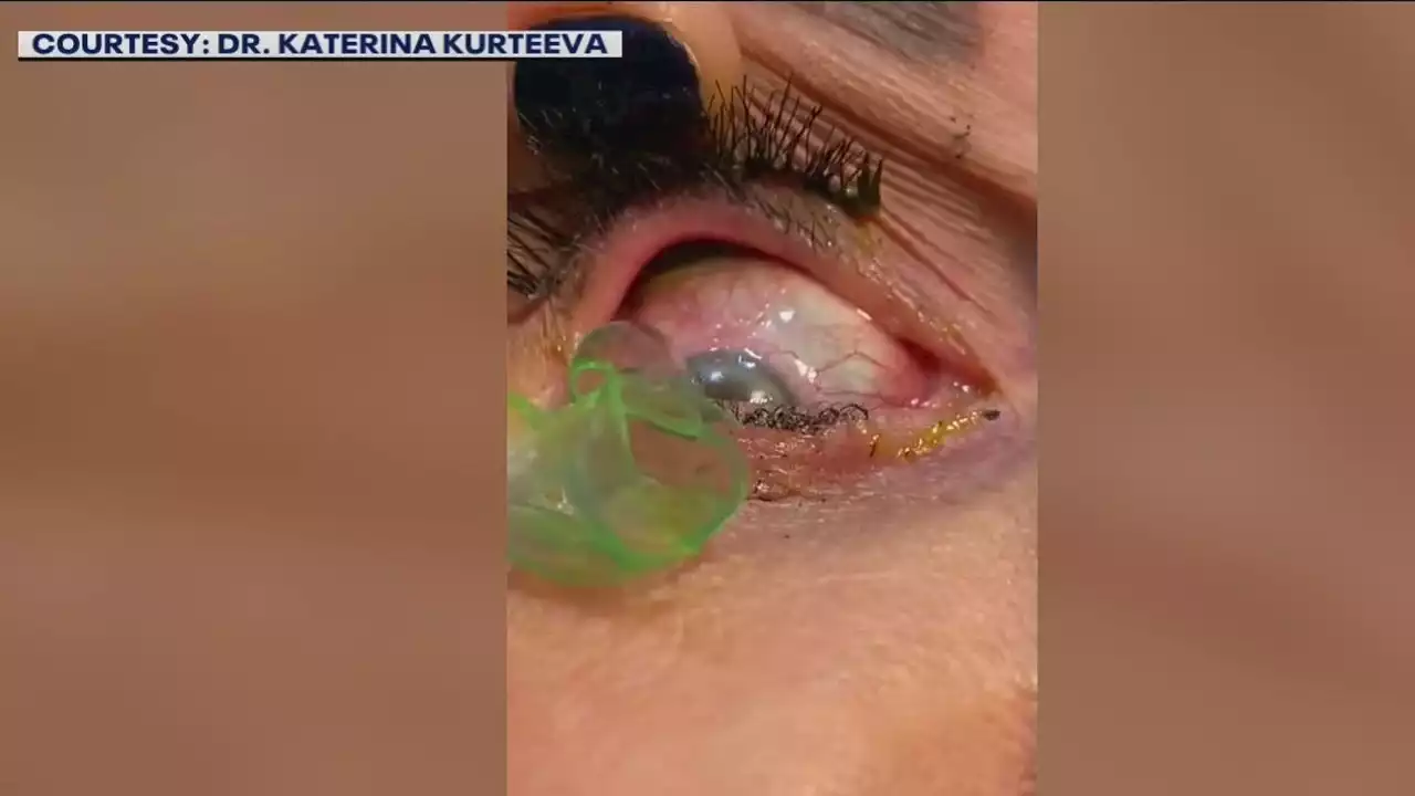 VIDEO: California doctor removes 23 contact lenses from woman's eye