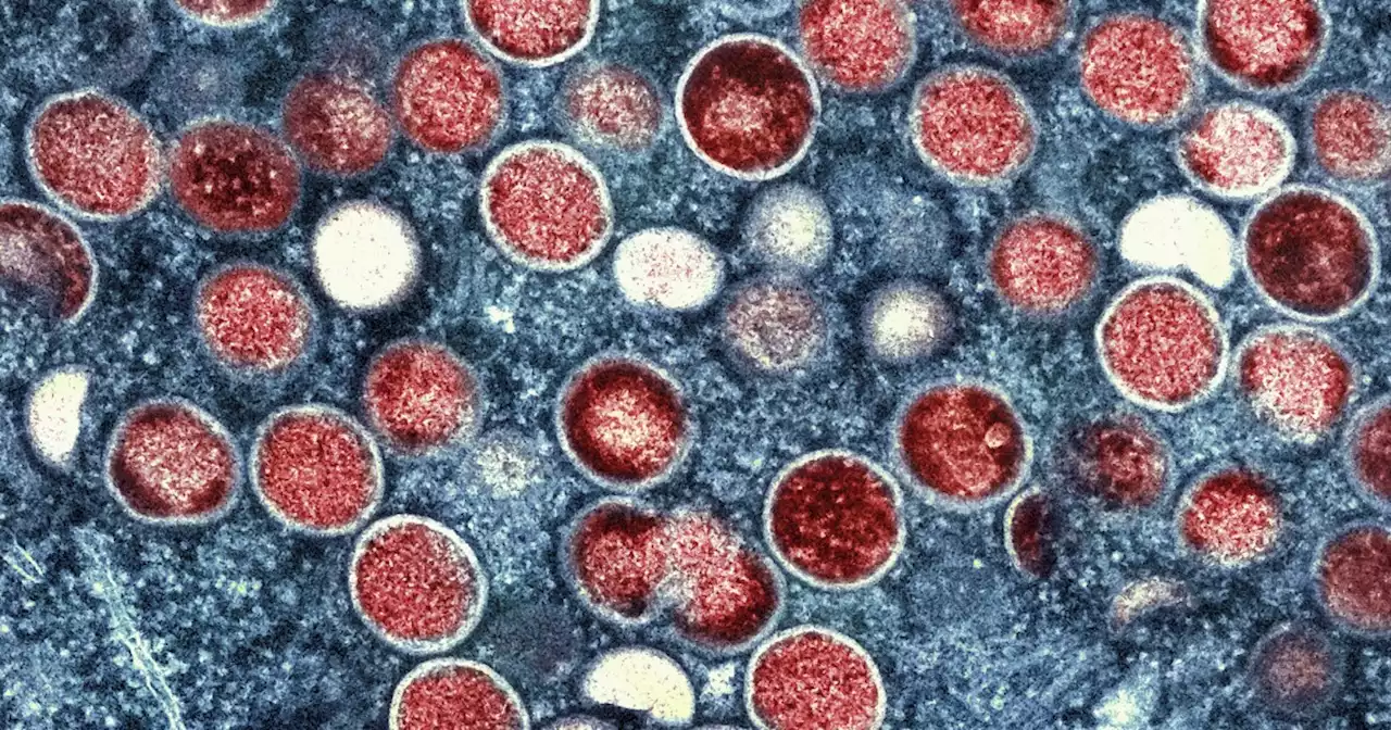 Monkeypox cases in the U.S. are way down — can the virus be eliminated?