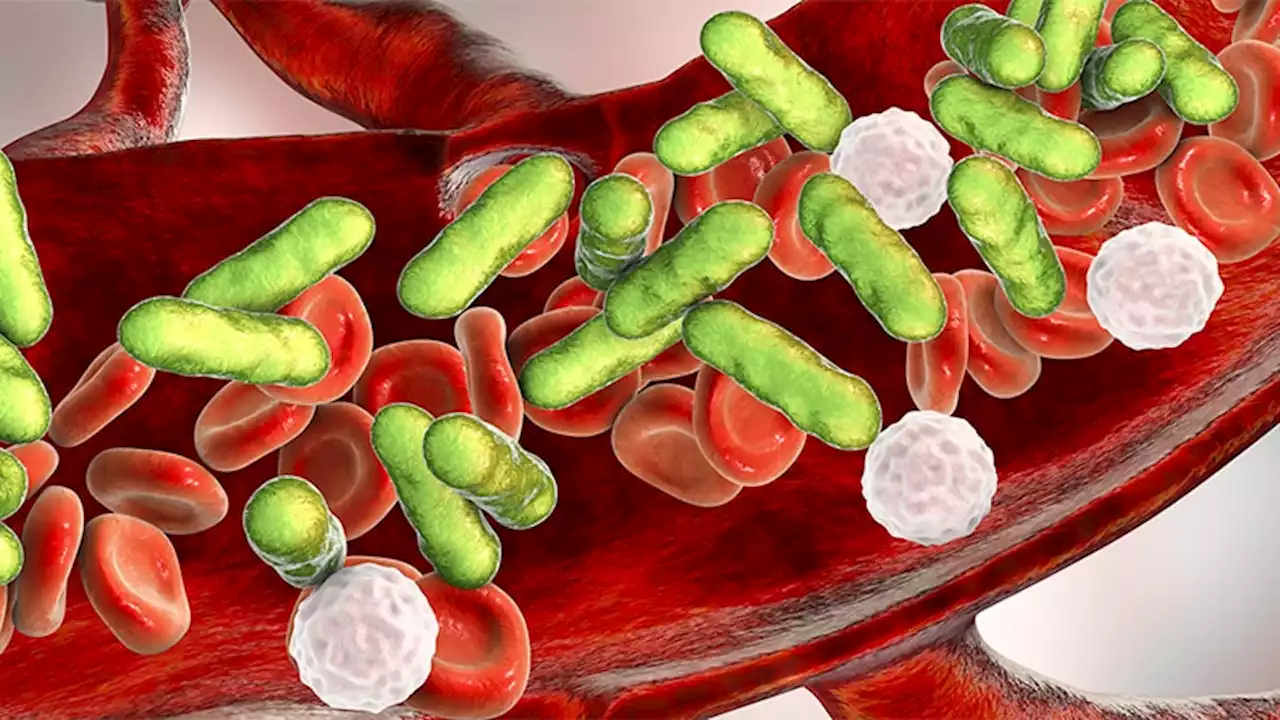 Sepsis Transition Program May Lower Mortality in Certain Patients