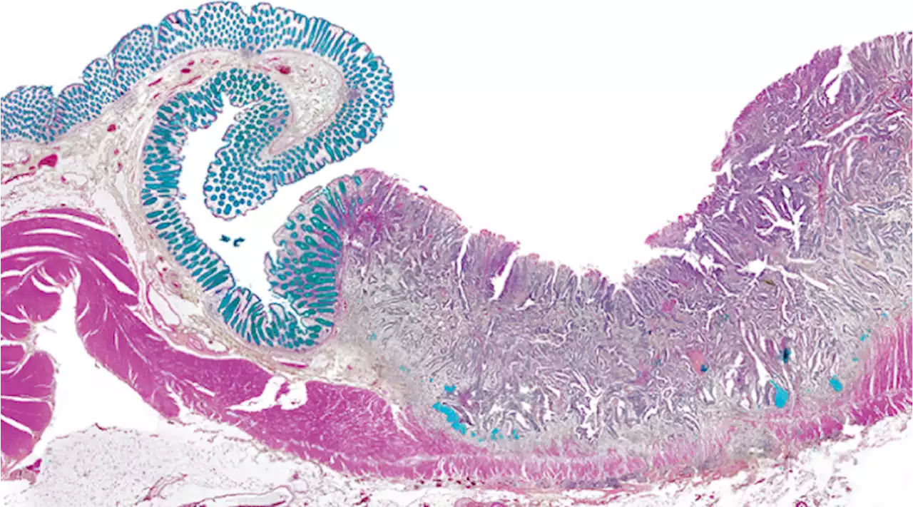 AI predicts cancer relapse from slides - Nature Biotechnology