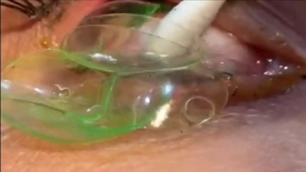 'Like a stack of pancakes': Doctor removes 23 contact lenses from patient's eye