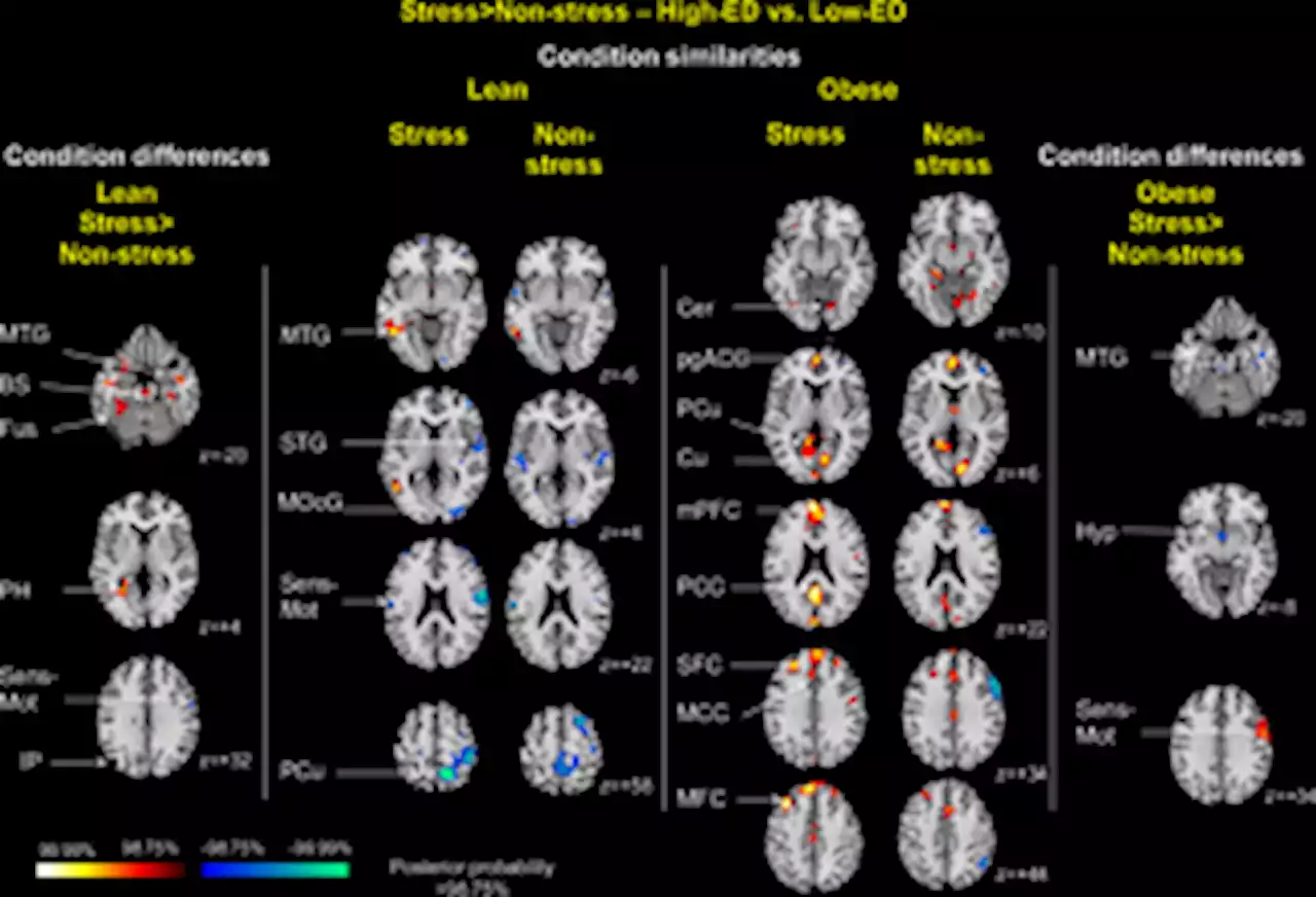 Obesity and acute stress modulate appetite and neural responses in food word reactivity task