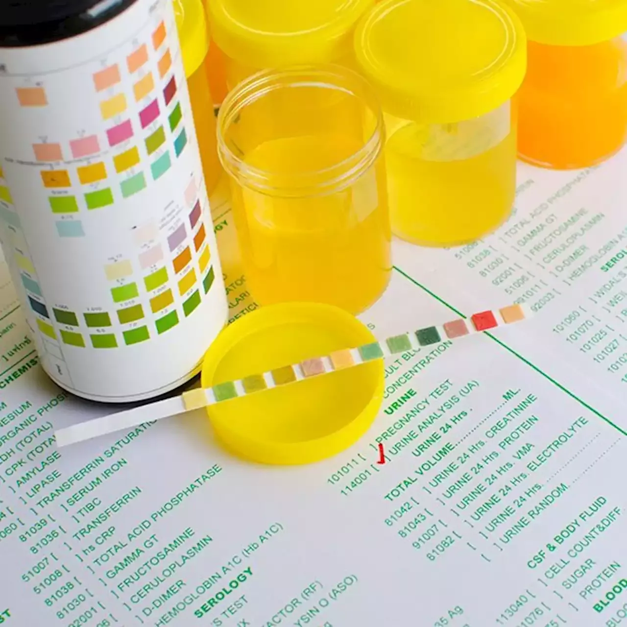 Urine: Why Does Your Pee Look Like That?