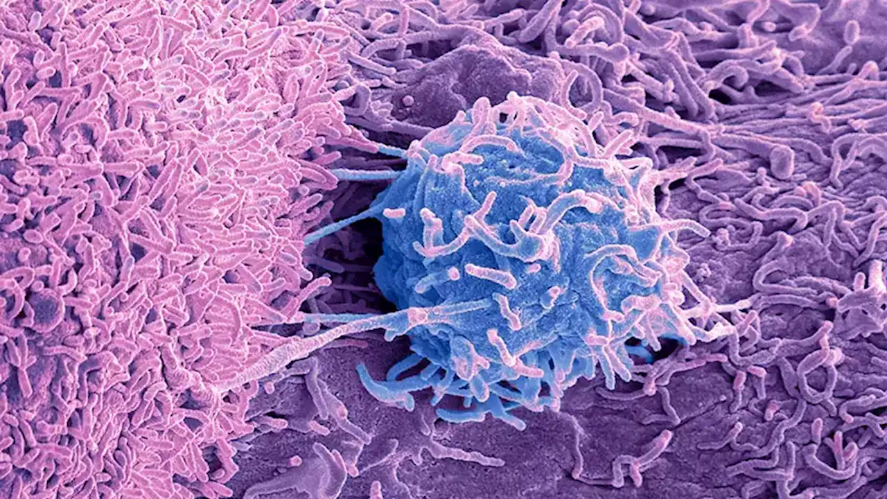 Two Factors to ID Men at Highest Risk for Prostate Cancer Death