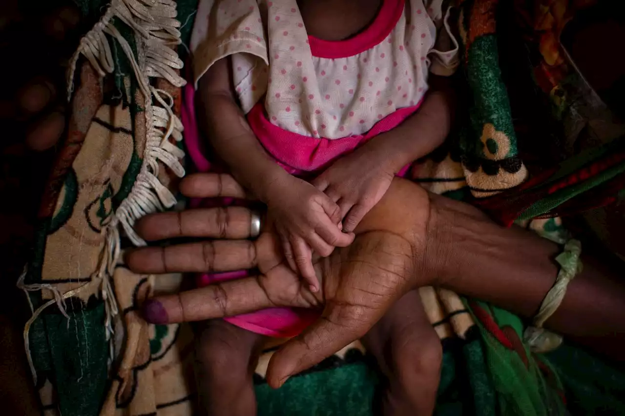 You can help save starving children around the world | Opinion