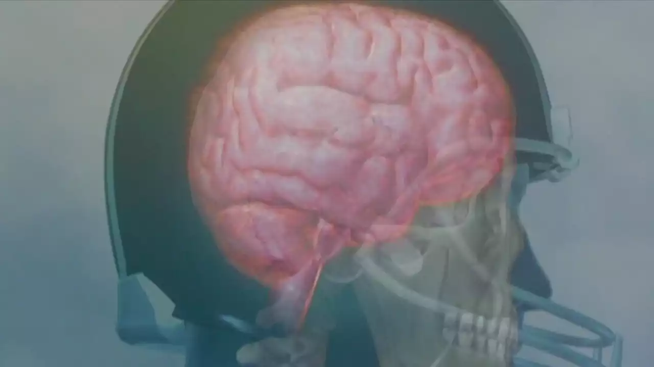 Researchers at UT Southwestern Medical Center want to study former college athletes' brain