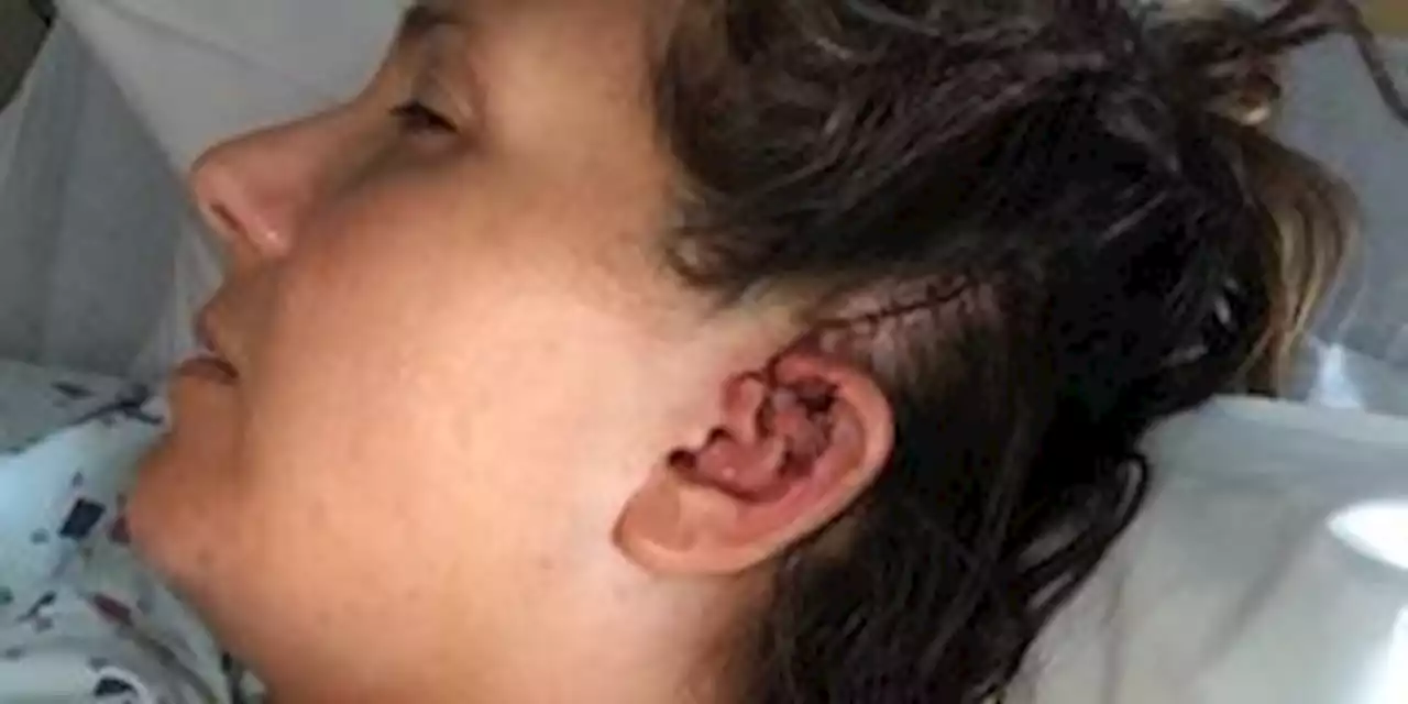 Runner Collides With Deer, Almost Loses Ear: ‘Like Getting Hit by an Asteroid’