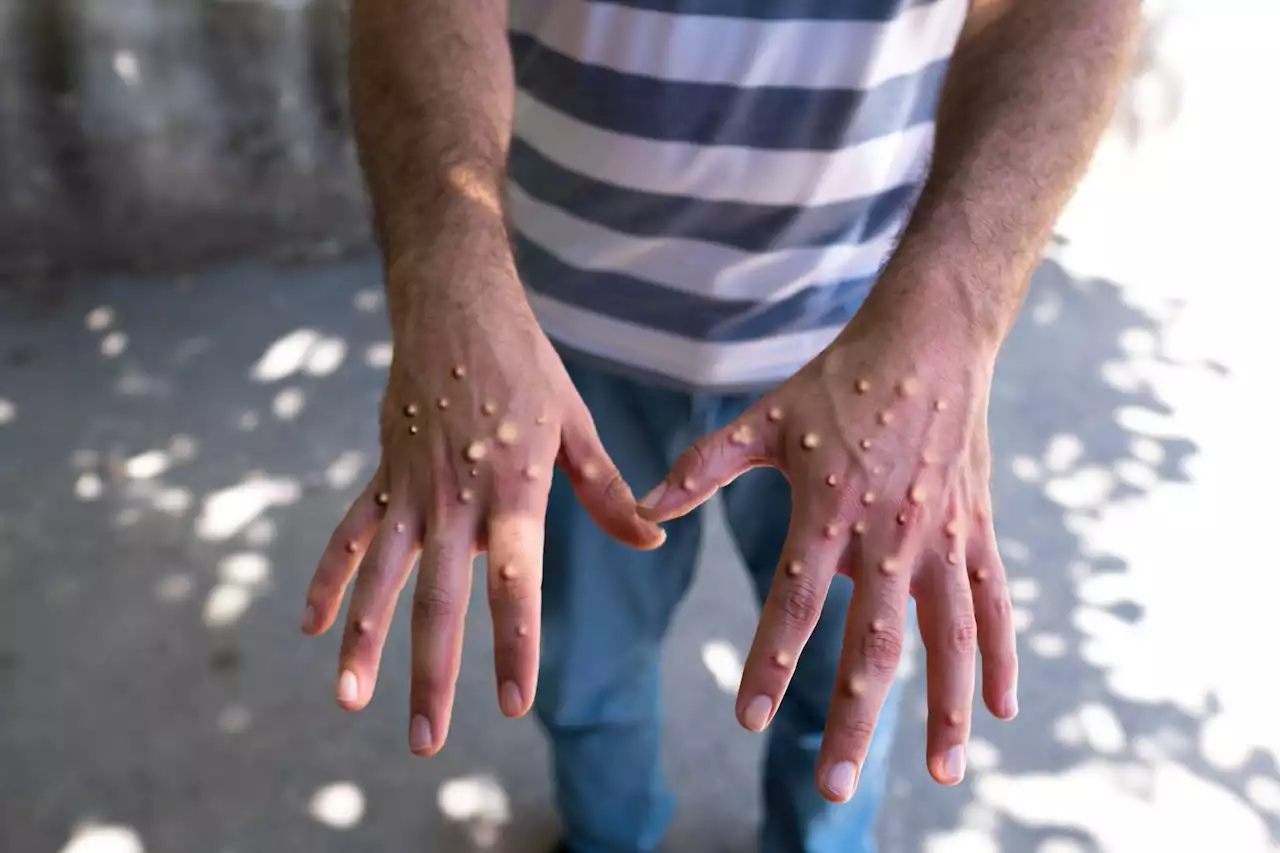 One in three miss their monkeypox vaccine appointment | Newstalk