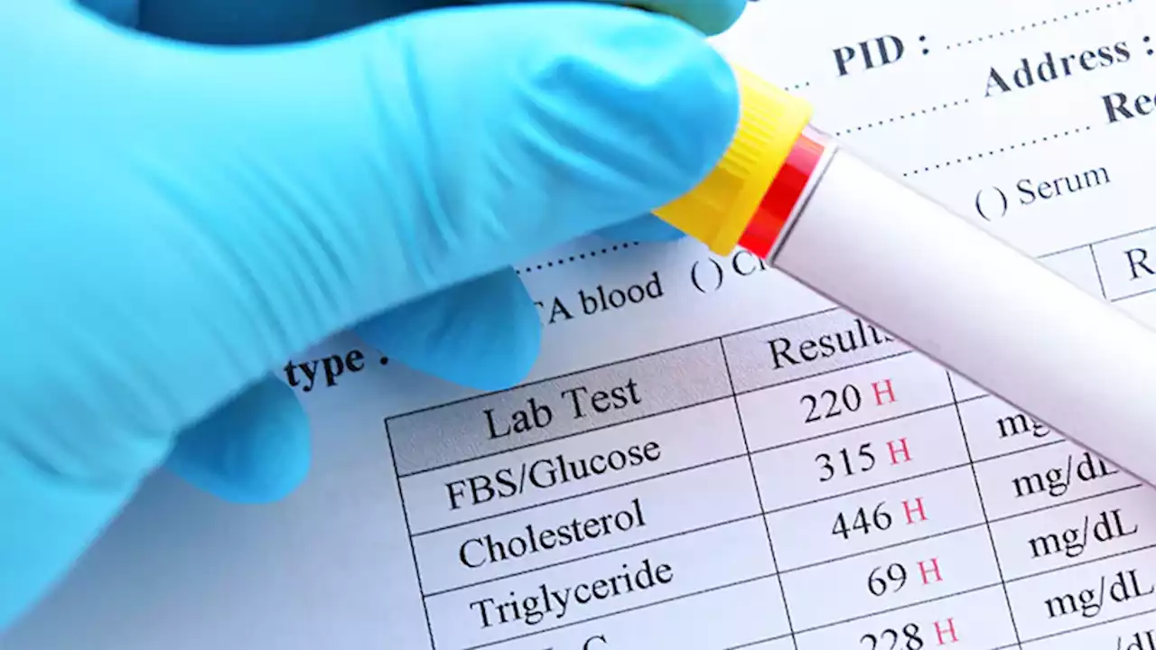 Do Lipid Labs Need to Be Fasting?