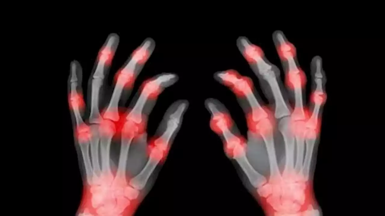 Newly discovered species of bacteria in microbiome may be culprit behind rheumatoid arthritis