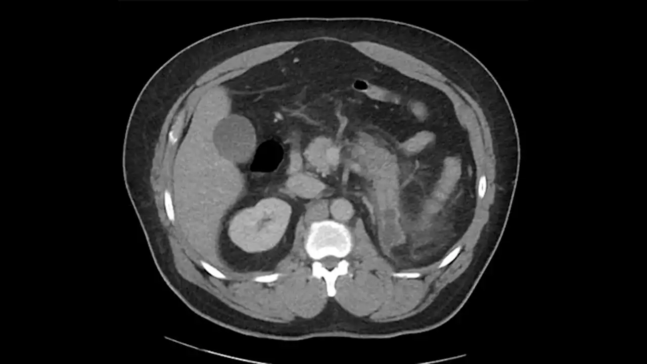 Pain, Vomiting in a 48-Year-Old on Levothyroxine, Metformin