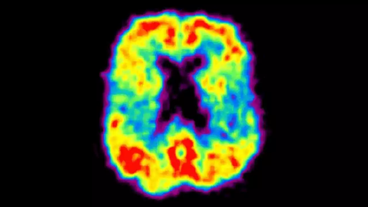 Risk Prediction Models Identify Presymptomatic Alzheimer's Disease