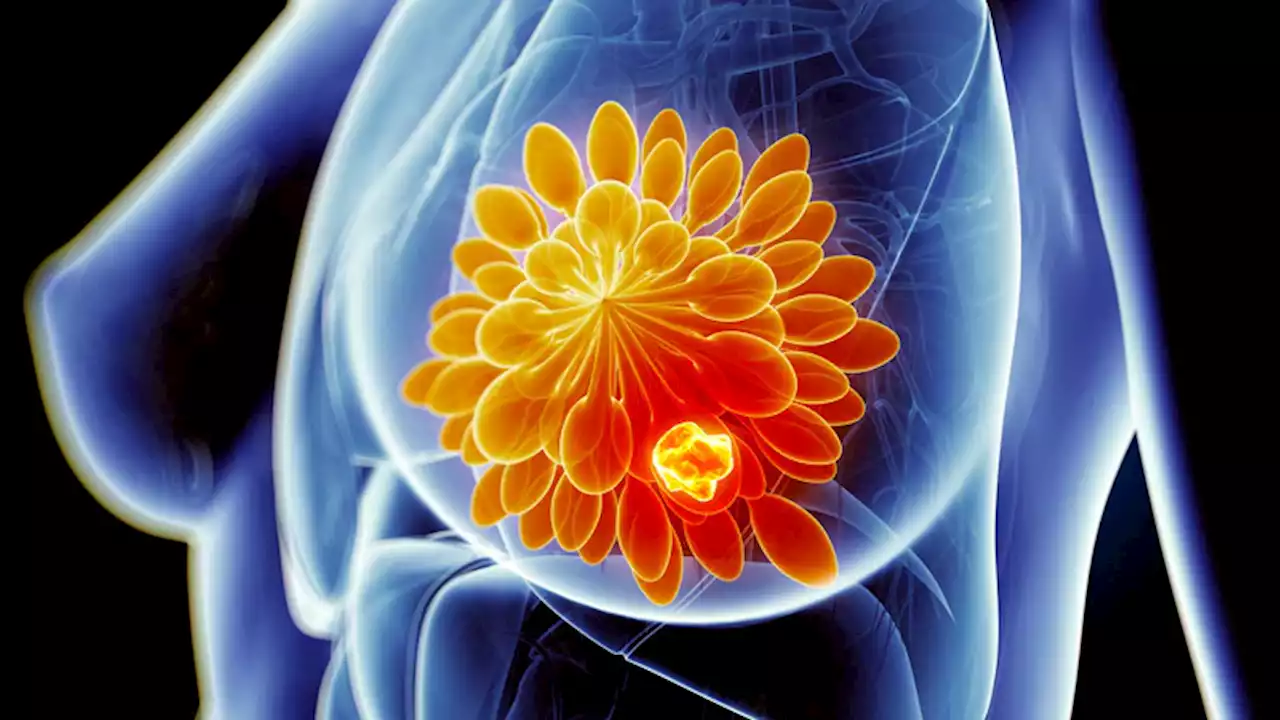 Statins After Diagnosis May Protect From Breast Cancer Mortality