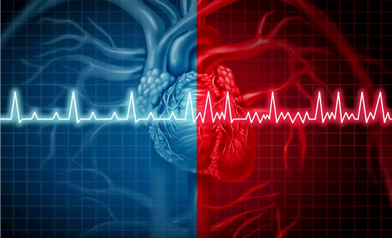 Sudden cardiac death risk can be determined by genetic score