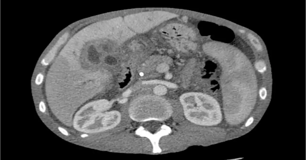 FDA Approves Futibatinib for Certain Biliary Tract Cancers