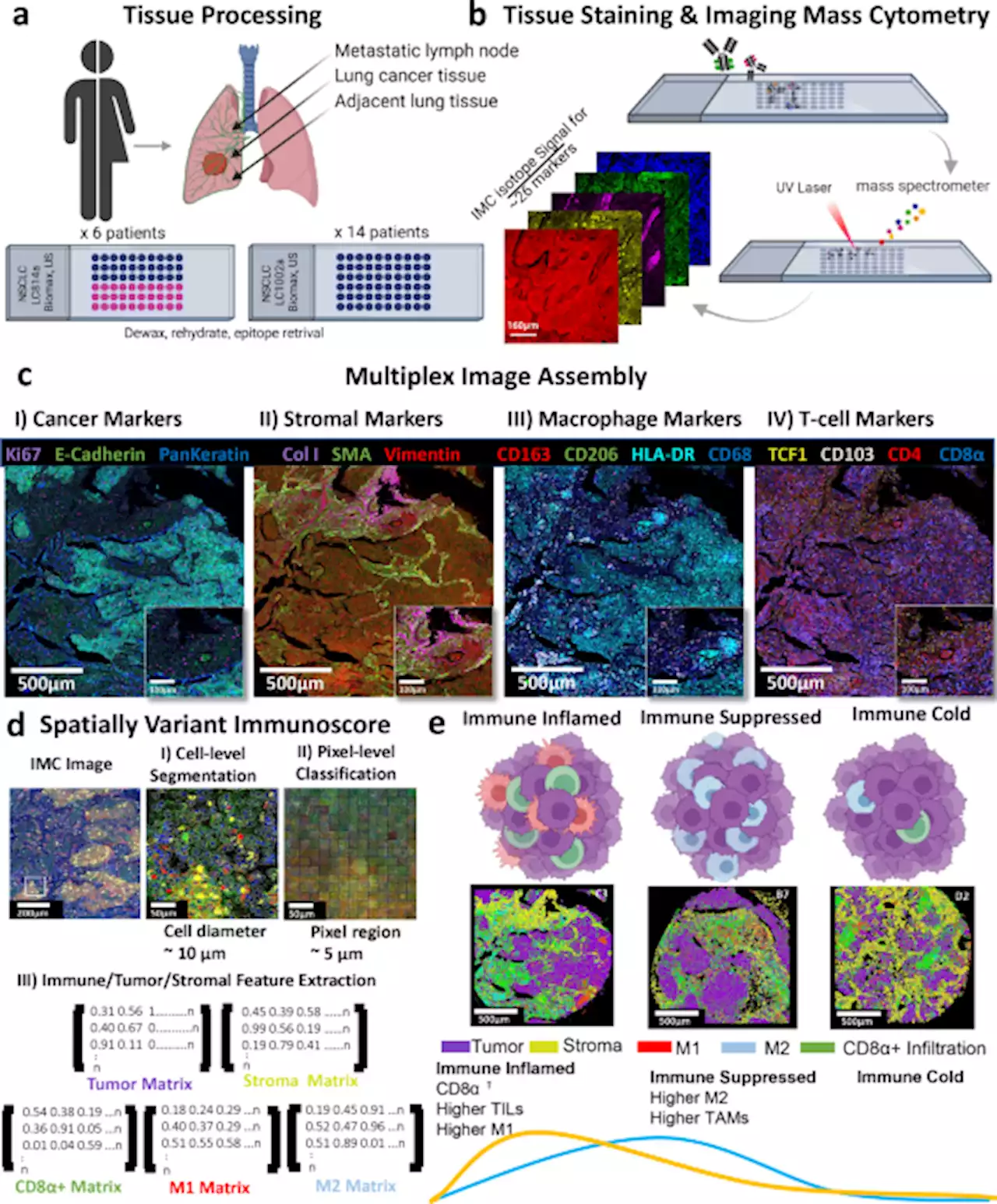 Spatially variant immune infiltration scoring in human cancer tissues - npj Precision Oncology