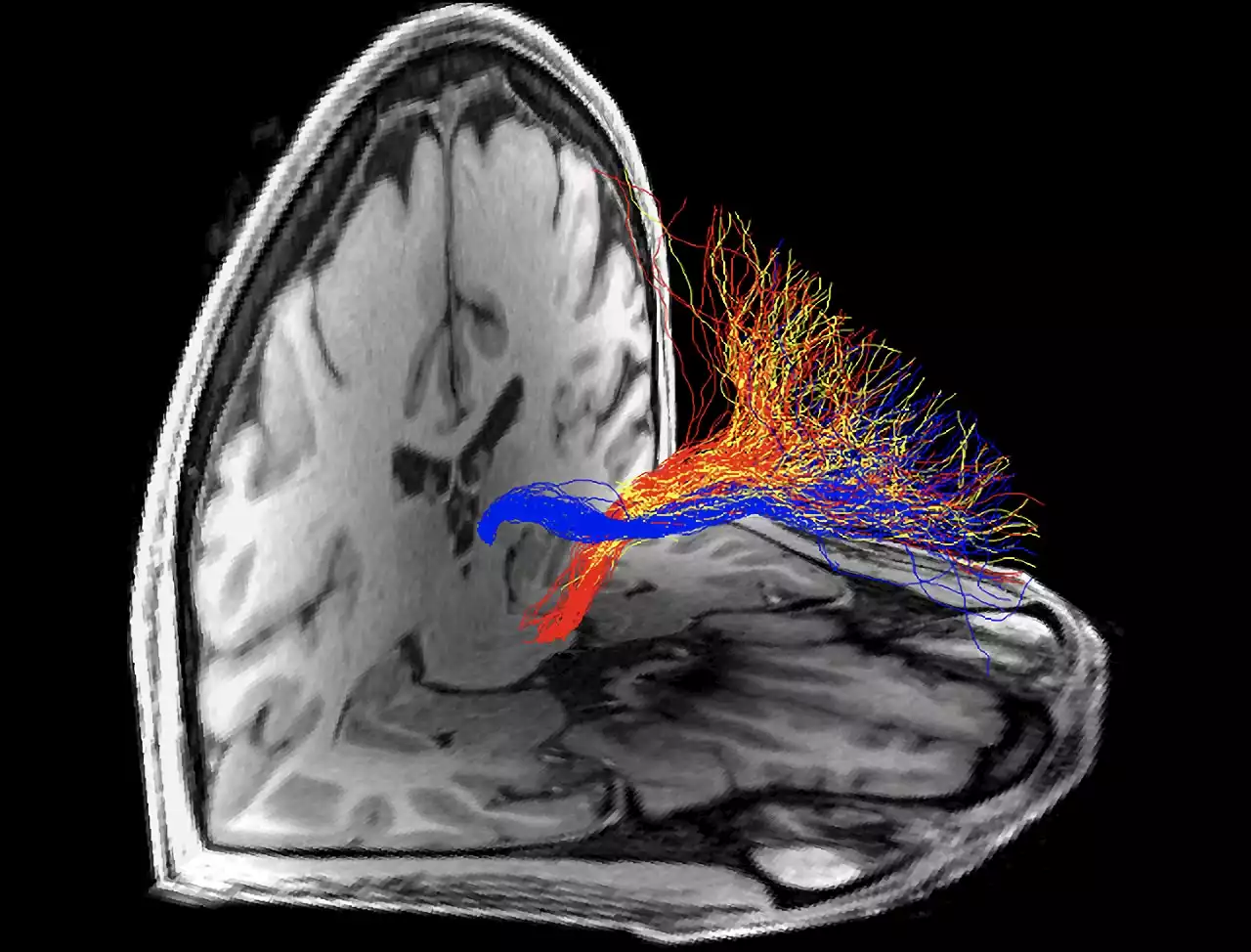 Human Cocaine and Heroin Addiction Is Tied to Impairments in Specific Brain Circuit