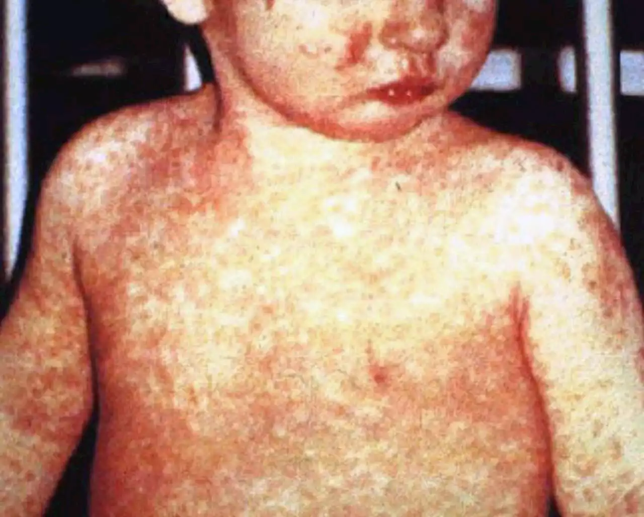 Measles outbreak temporarily closes childcare facility in Columbus