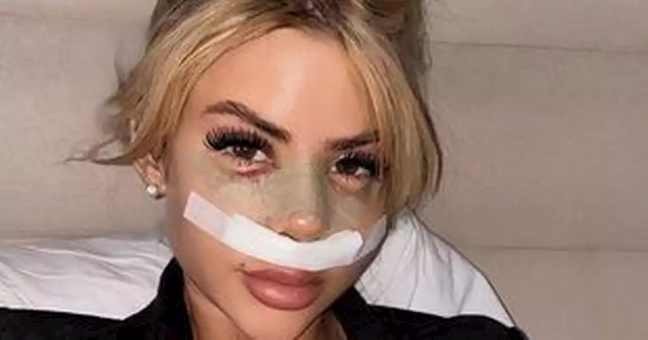 Love Island's Hannah Elizabeth 'looks like Bratz Doll' as she shows off surgery