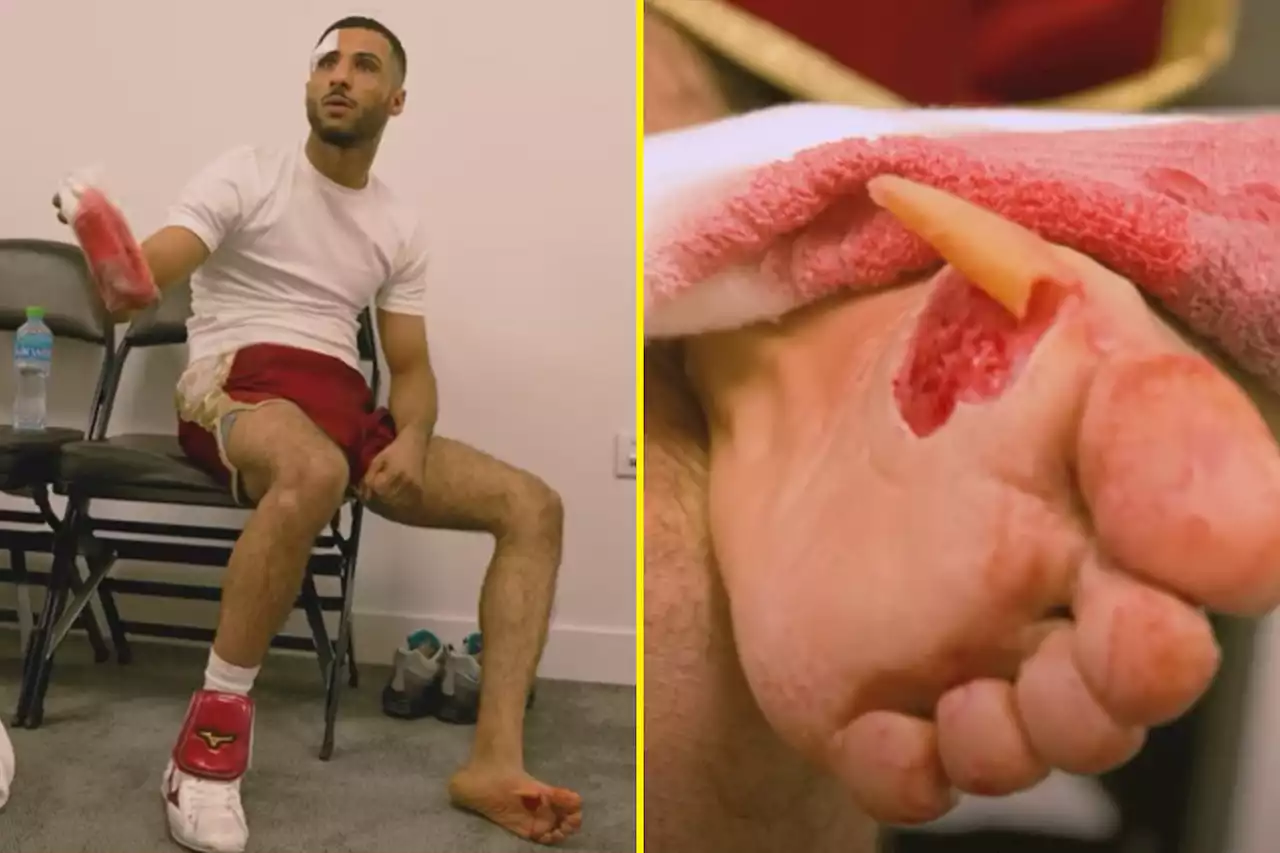 Olympic gold medalist Galal Yafai shows off the horrific injury he suffered mid-fight