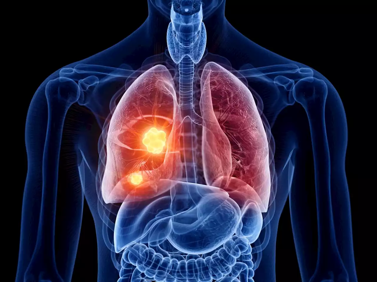 Lung Cancer | CDC