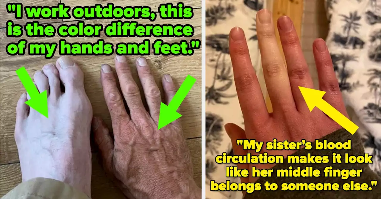 Raynaud's Disease, Symphalangism, And 15 More Fascinating Body Abnormalities People Are Proudly Sharing