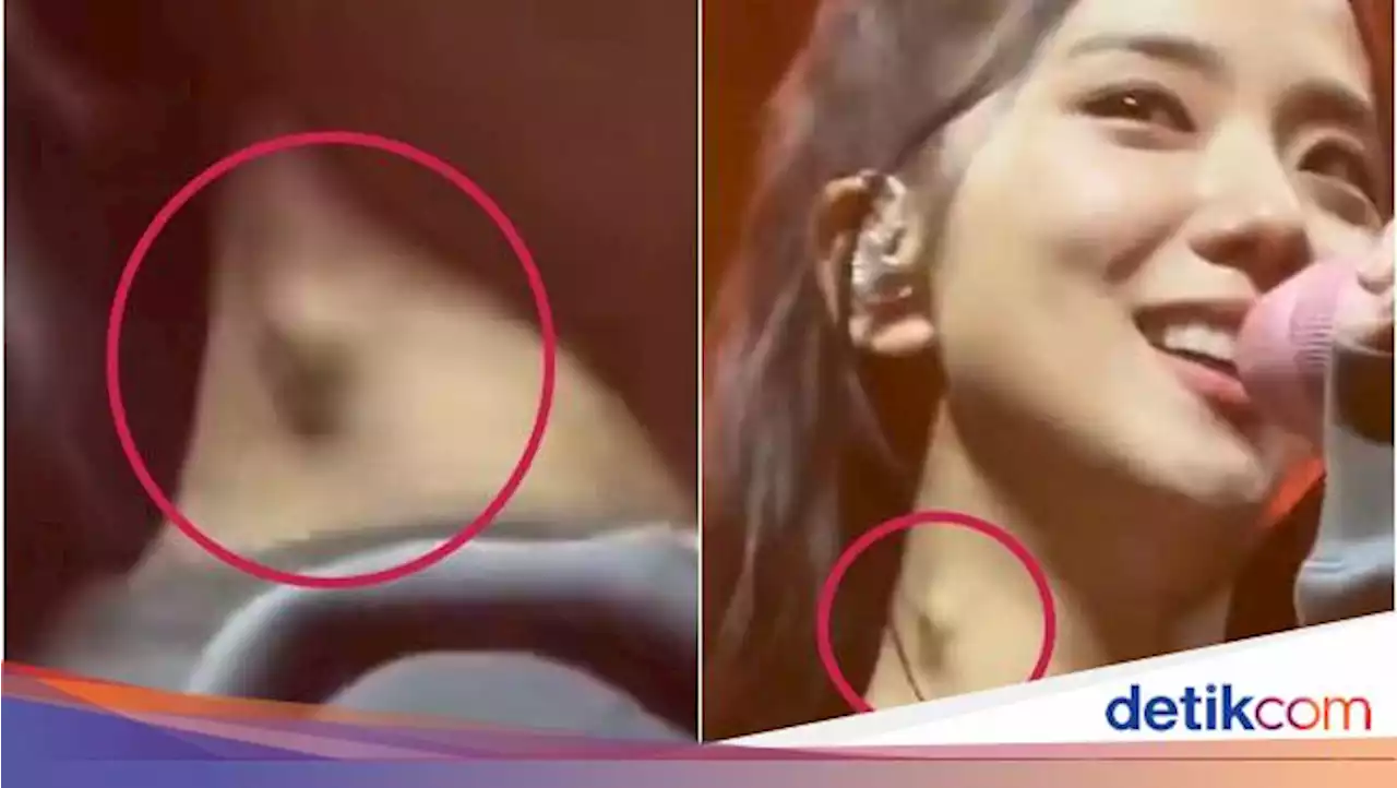 Jisoo BLACKPINK Ada Benjolan di Leher Sampai Diduga Kena Tumor, Apa Penyebabnya?