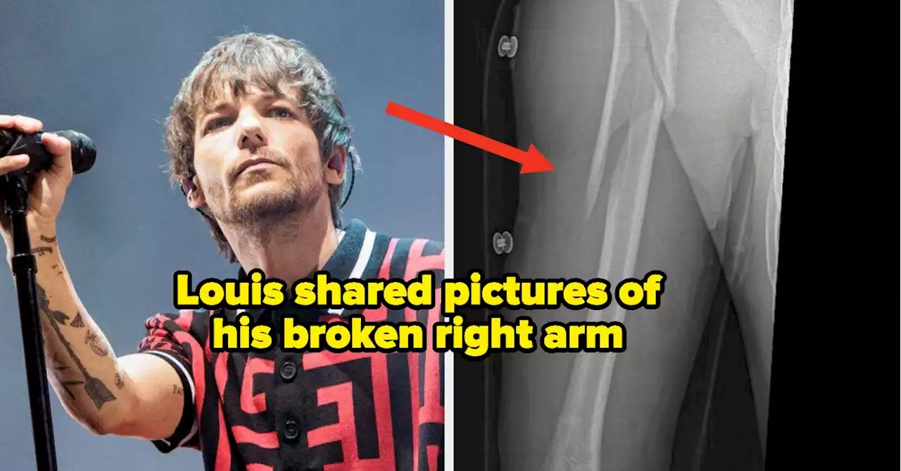 Louis Tomlinson Broke His Arm, And Had Some Bad News For His Fans